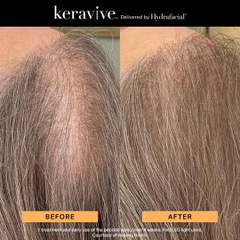 Before and after Keravive treatment showing improved hair coverage at the crown