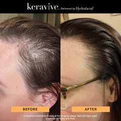 Before and after Keravive treatment showing fuller hairline