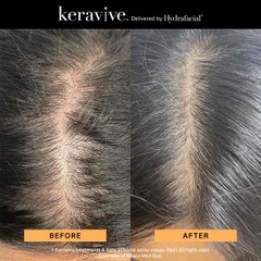 Before and after Keravive treatment showing improved scalp health along the hair part