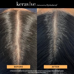 Before and after Keravive treatment showing improved hair density on top of head