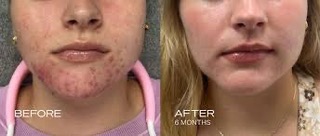 Before and after chemical peel treatment for acne showing clearer skin after 6 months