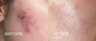 Before and after chemical peel treatment for body acne showing significant clearing after 1 year