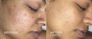 Before and after chemical peel treatment for pigmentation showing more even skin tone after 7 months